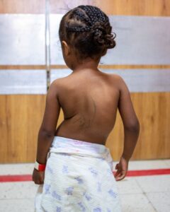 A small child with her back facing the camera so that the twist in her spine is obivous. 
